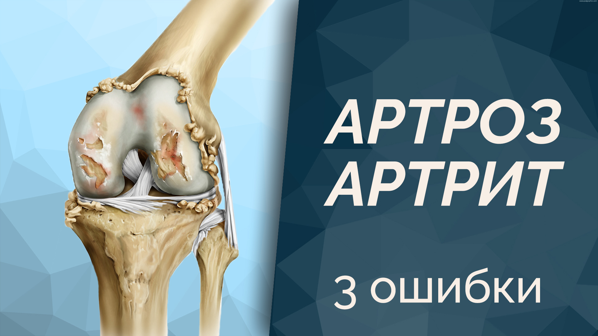 3 ошибки в лечении Артроз и Артирт смотреть онлайн