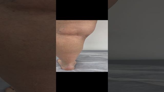 Сосудистая сетка на ногах. Планируем склеротерапию. Флеболог Москва. Флеболог смотреть онлайн