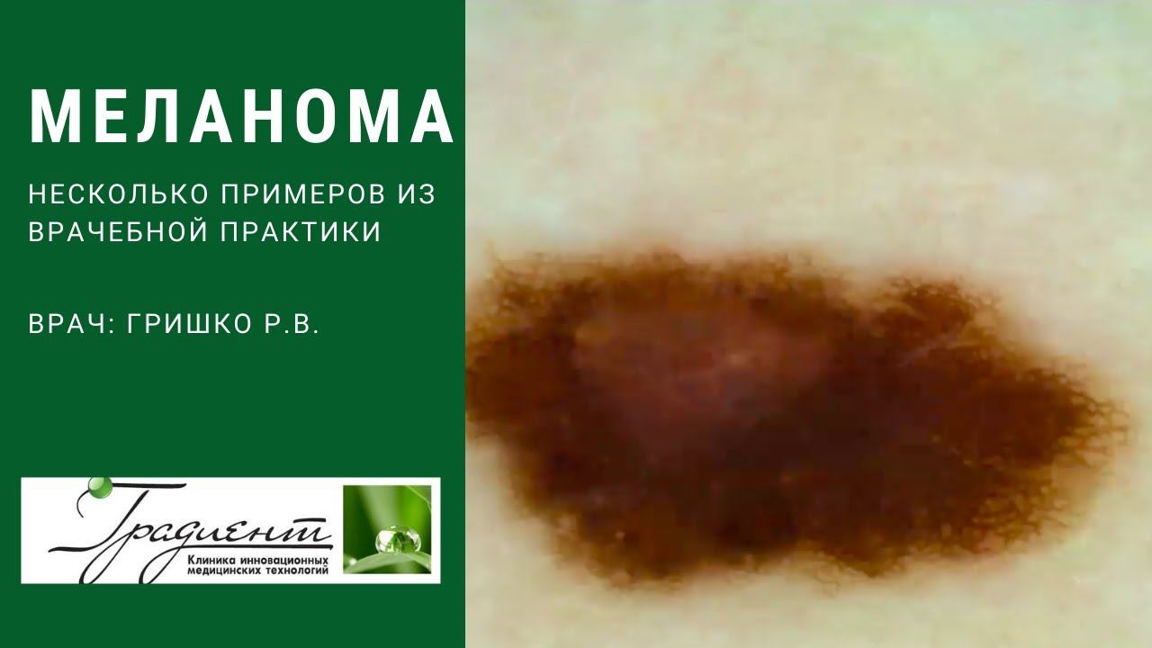 КАК ВЫГЛЯДИТ МЕЛАНОМА? Случаи из врачебной практики определения меланомы кожи. смотреть онлайн