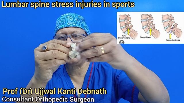 Lumbar spine stress injuries in Sports. || Prof(Dr) Ujjwal Kanti Debnath. смотреть онлайн