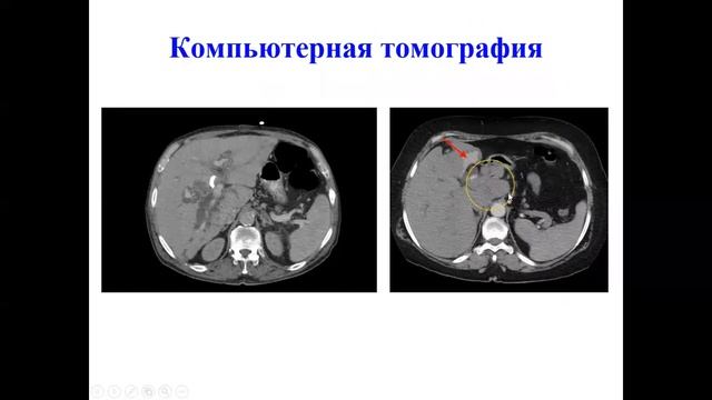 Механическая желтуха