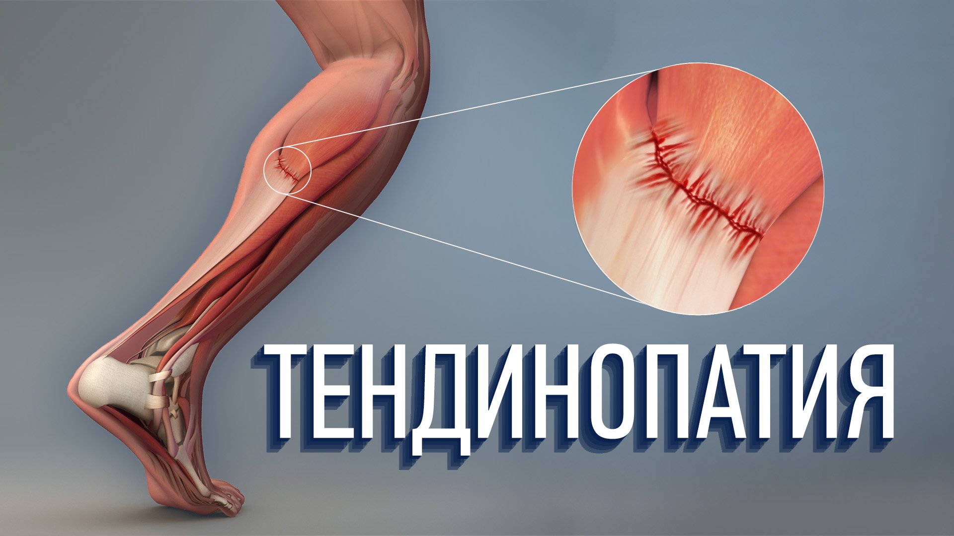 Тендинопатия. Как ее лечить? Что это такое? смотреть онлайн