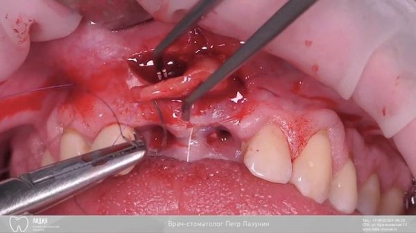 Пластика десны