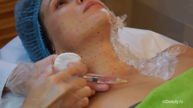 Биоревитализация #9