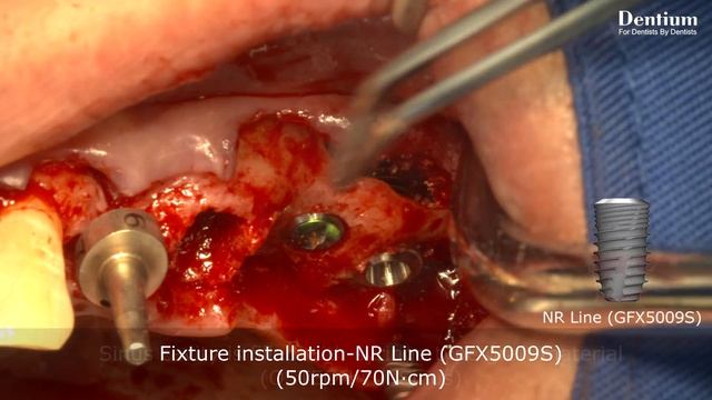 Sinus elevation using DASK смотреть онлайн