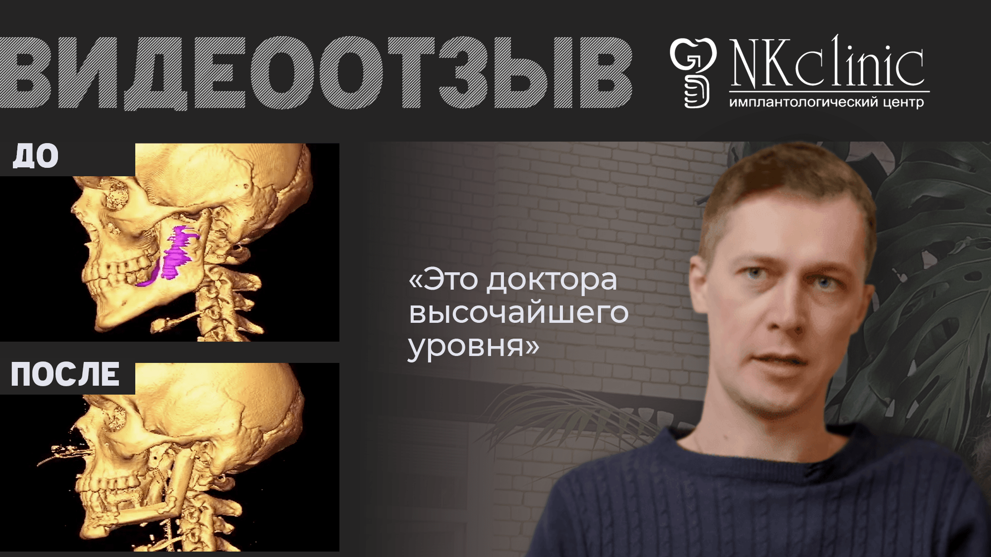 NKclinic - отзывы пациентов. После удаления амелобластомы проснулся сразу с зубами.