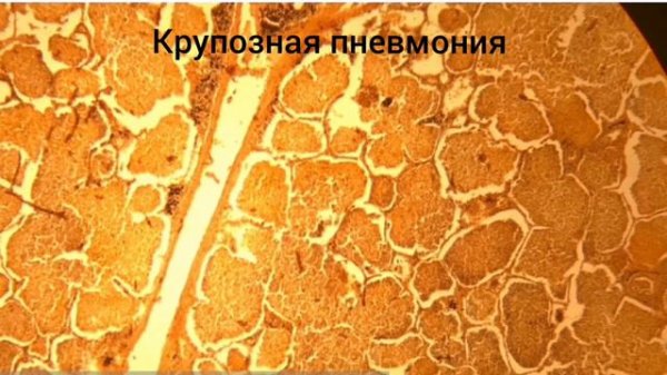 Крупозная пневмония