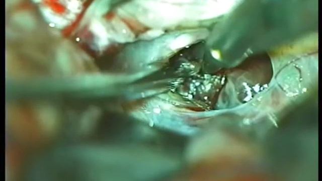 Удаление ангиомы и гематомы ножки мозга смотреть онлайн