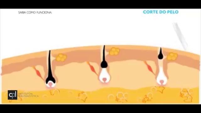 Fotodepilación смотреть онлайн