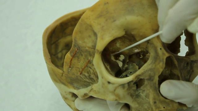 11. Глазница - строение стенок, отверстия