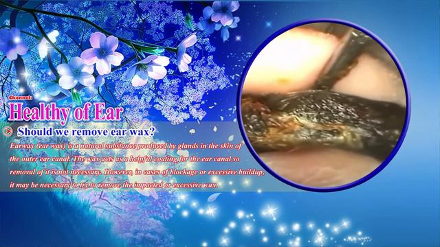 удаление холестеатомы #09 смотреть онлайн