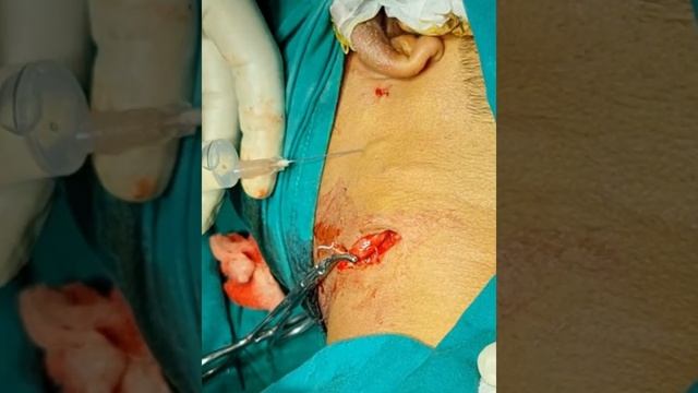 tuberculous lymphatic Chanel n superficial neck vein. dr jalil mujawar смотреть онлайн