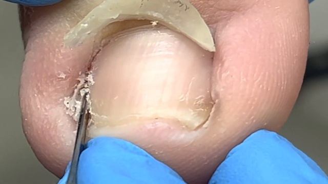 Inflamed toenails, trim excess ingrown nails【Xue Yidao Pedicure】 смотреть онлайн