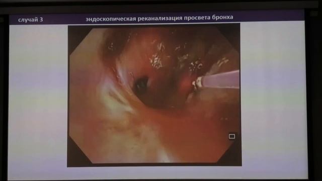 09 Соколов ВА Оперативная бронхология Оценка возможных осложнений и пути их профилактики смотреть онлайн
