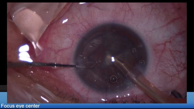 Oculentis Comfort Toric Lukan Mishev Live Stream смотреть онлайн