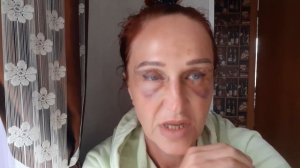 Как проходит реабилитация. Мой опыт. #блефаропластика