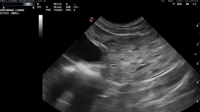 Benign prostatic hyperplasia and intraprostatic cysts смотреть онлайн