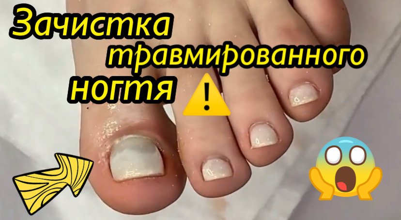 Зачистка травмированного ногтя?⚠️??❗️ смотреть онлайн