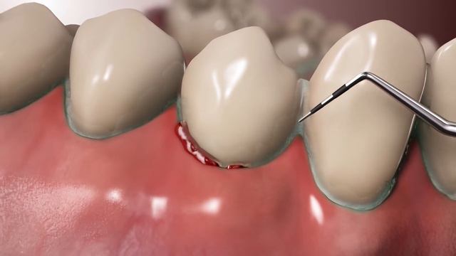 쉬운말) 3D 애니메이션 : 임플란트주위염과 예방법에 대하여(Peri-Implantitis and its prevention) смотреть онлайн