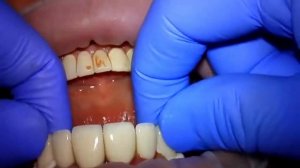 Установка металлокерамических коронок в клинике KRH Medical