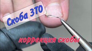 ?ВРОСШИЙ НОГОТЬ  _ СКОБА 3ТО _ КОРРЕКЦИЯ СКОБЫ 3ТО