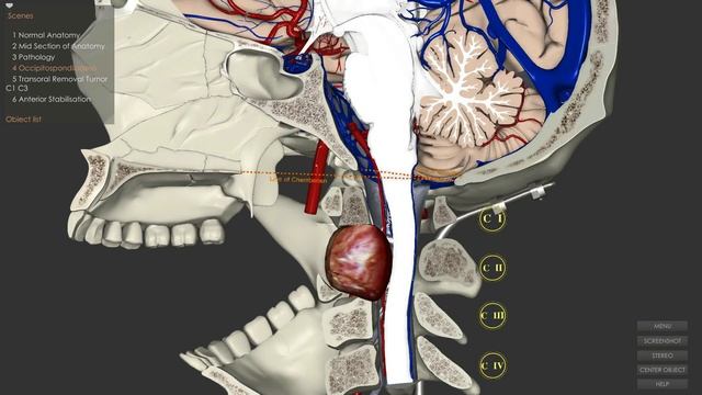 Стабилизация верхнешейного отдела позвоночника (C1-C2) из переднего доступа смотреть онлайн