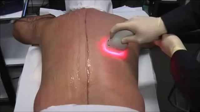 Asclepion MeDioStar NeXT vs. Lightsheer DUET: скорости проведения лазерной эпиляции смотреть онлайн