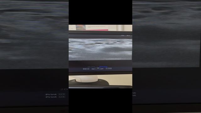 Варикоз на половых губах. Варикоз в брюшной полости. Узи сосудов. Флеболог Москва смотреть онлайн