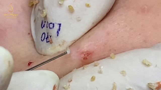 Remove hidden acne under the skin (70) | Loan Nguyen смотреть онлайн