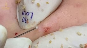 Remove hidden acne under the skin (70) | Loan Nguyen