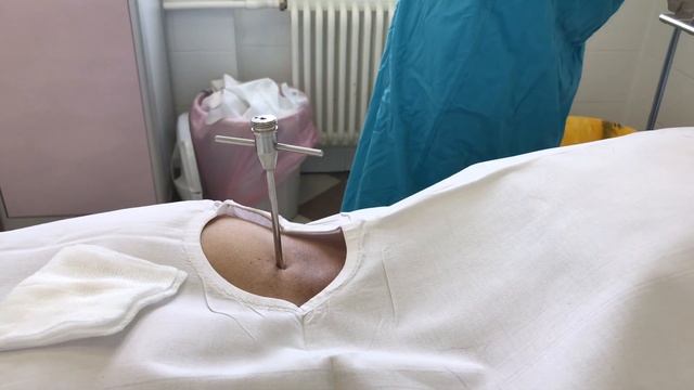 Трепанобиопсия костного мозга г.Москва смотреть онлайн