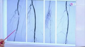 Атеросклероз сосудов нижних конечностей  поражает преимущественно курящих мужчин старше 40 лет!.mp4