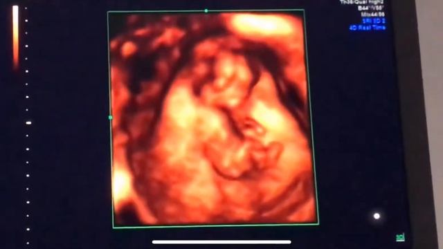 12 неделя беременности после ЭКО Эмбрион 3Д изображение наш маленький сынок смотреть онлайн