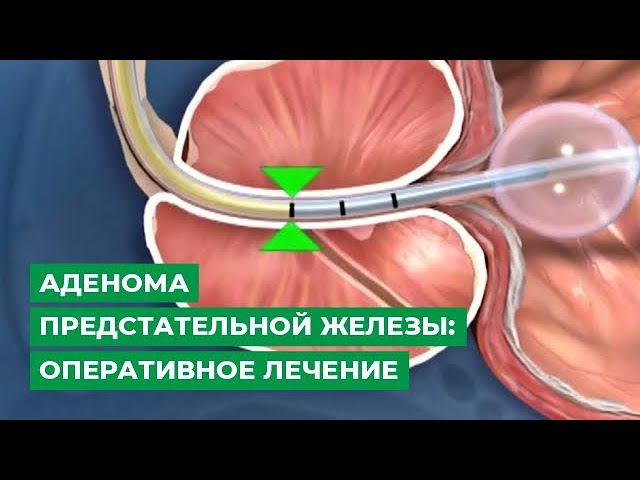 Можно Ли Заниматься Сексом При Аденоме Можно Ли Заниматься Сексом При Аденоме