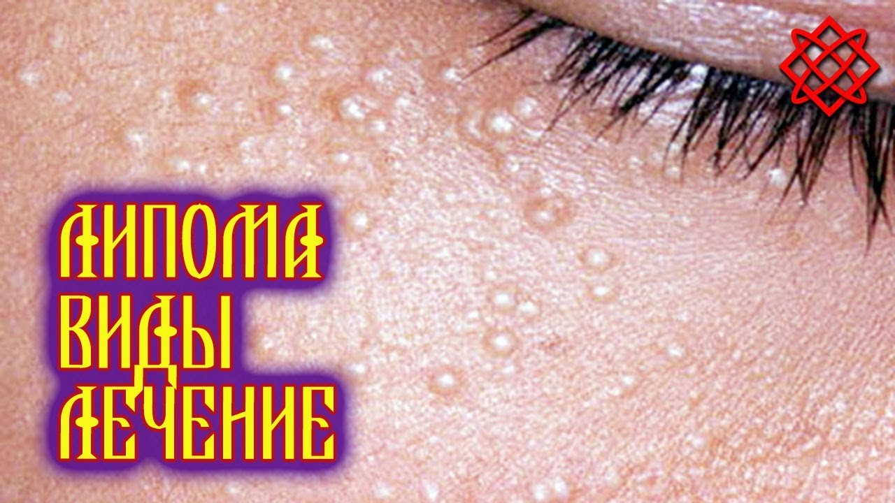 ЛИПОМА. Лечение Липомы в Домашних Условиях. Жировики на Лице и Теле.mp4