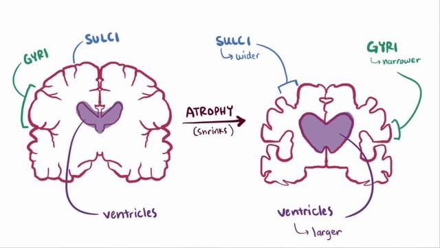 Alzheimer's Disease - Plaques, Tangles, Causes, Symptoms & Pathology