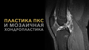 Пластика ПКС и мозаичная хондропластика