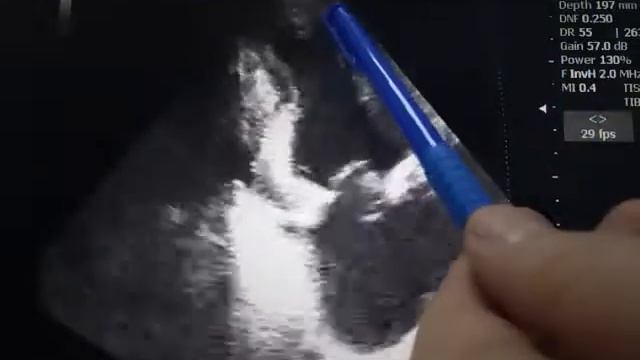 Тяжелый аортальный стеноз, Тромб левого желудочка смотреть онлайн