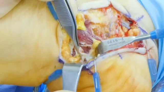 Live Tarsal Tunnel and Baxters Nerve Surgery Narrated by Dr. Bregman