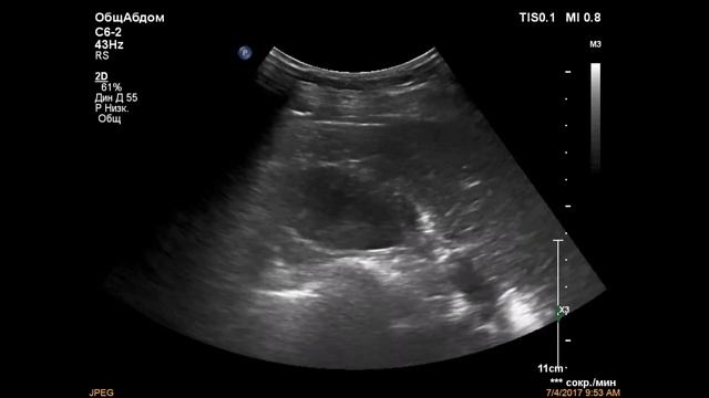 Гипоплазия правой почки смотреть онлайн