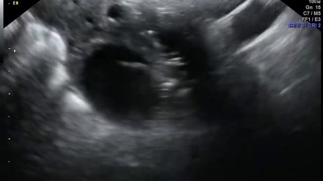 Сактосальпинкс медикаментозный после эхогистеросальпингоскопии смотреть онлайн