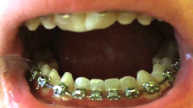 Braces - How to use a waterpik смотреть онлайн