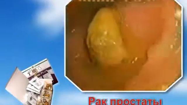 Рак. Чистый кишечник-залог вашего здоровья. смотреть онлайн