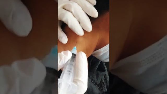 FNAC Of Cervical Lymph Node।। смотреть онлайн