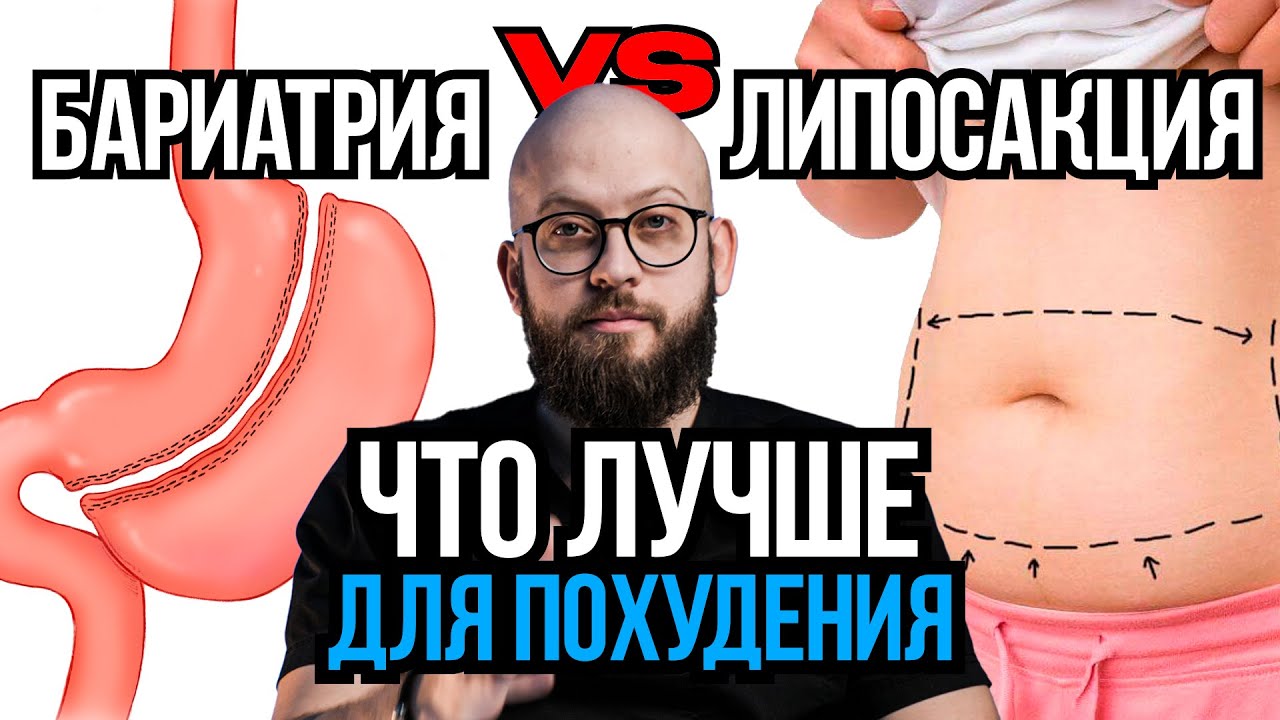 Бариатрия или липосакция - что эффективнее смотреть онлайн