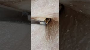 Belly Button Blackhead (Umbolith or Navel Stone) Removal