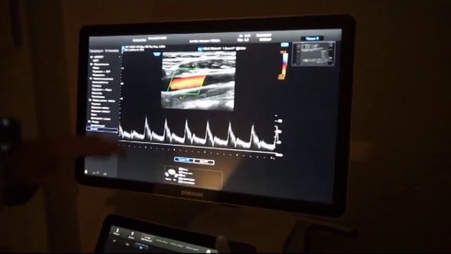Ультразвуковая система Samsung RS80A - УЗИ-аппарат премиум класса в МЦ Панацея смотреть онлайн