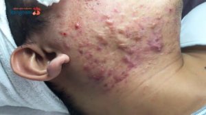 Выдавливаеи прыщи и чёрные точки 04.06.2020