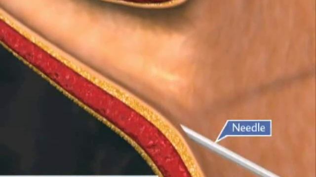 Endoscopic treatment for V.U.Reflux - Deflux Injection 1 смотреть онлайн