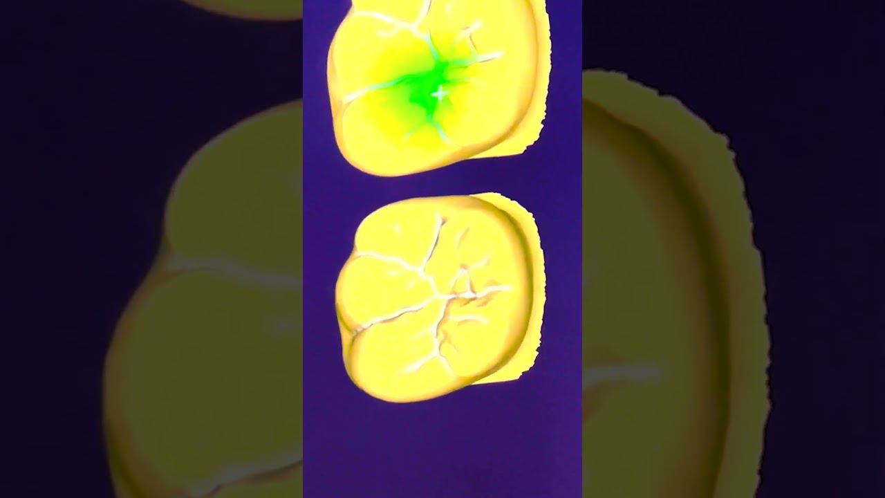 Зубной техник обучение #зубнойтехникмосква #cadcam #зуботехническаялаборатория #курсызубнойтехник смотреть онлайн